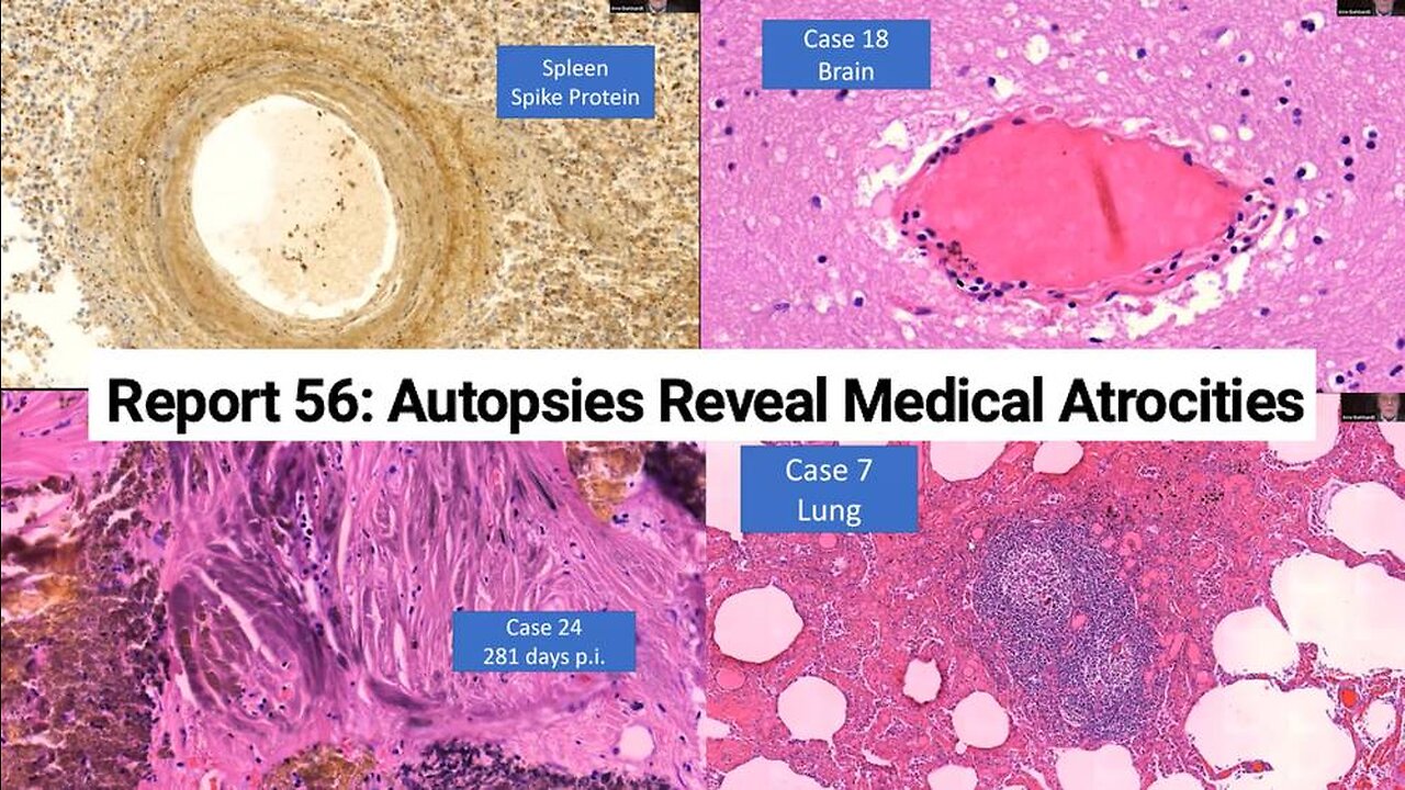 "It's A Bio Weapon" Autopsies From Report 56 Reveal Medical Atrocities From COVID Shots