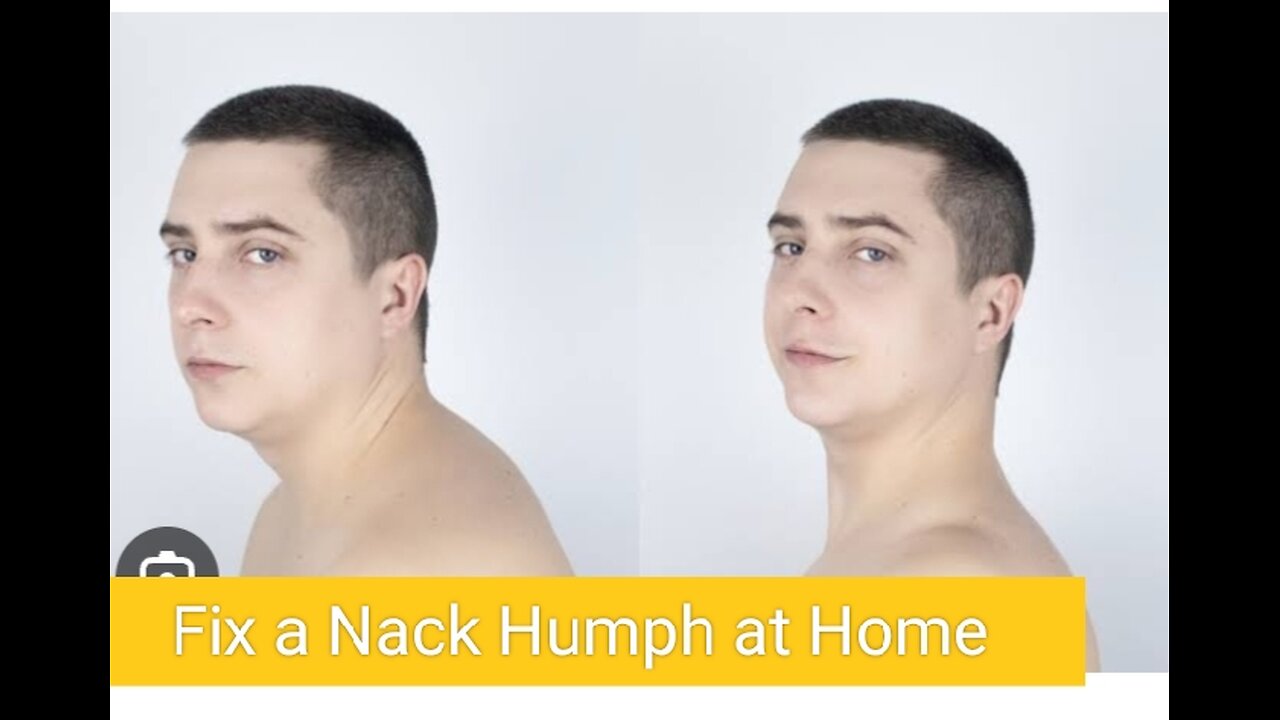 How to fix a neck hump at home
