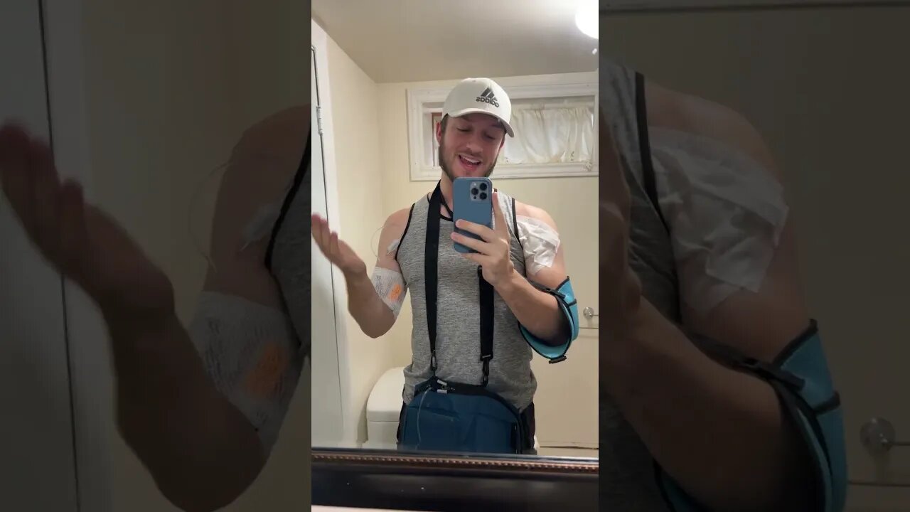 Long 2 Year Pec Tear Journey