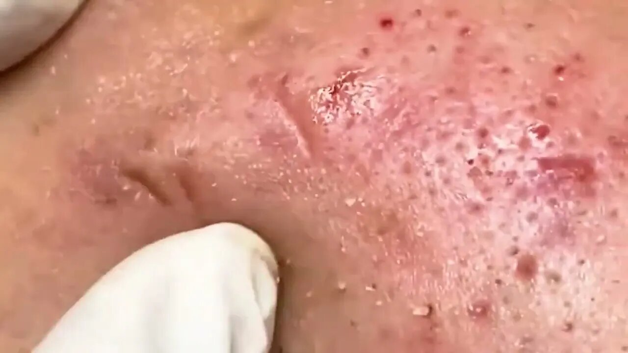 Satisfactory Video Blackhead Removal Skin Cleansing #20 | 2022 Video