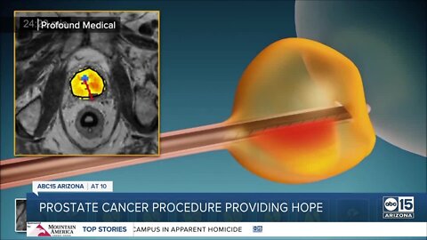 A new treatment option for men battling prostate cancer