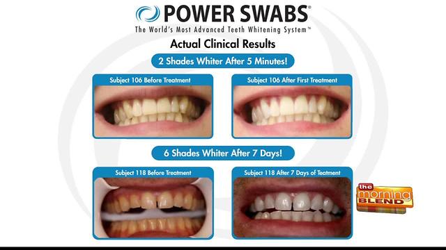 Whitening yellow teeth from coffee, red wine and smoking