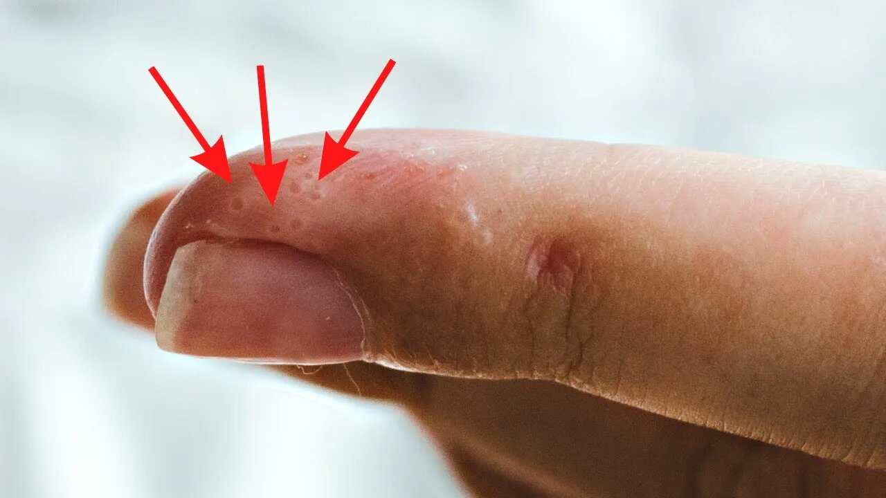 Bolinhas Nas Mãos e Nos Pés: Veja O Que Significam E O Que Fazer Para Tratá-las