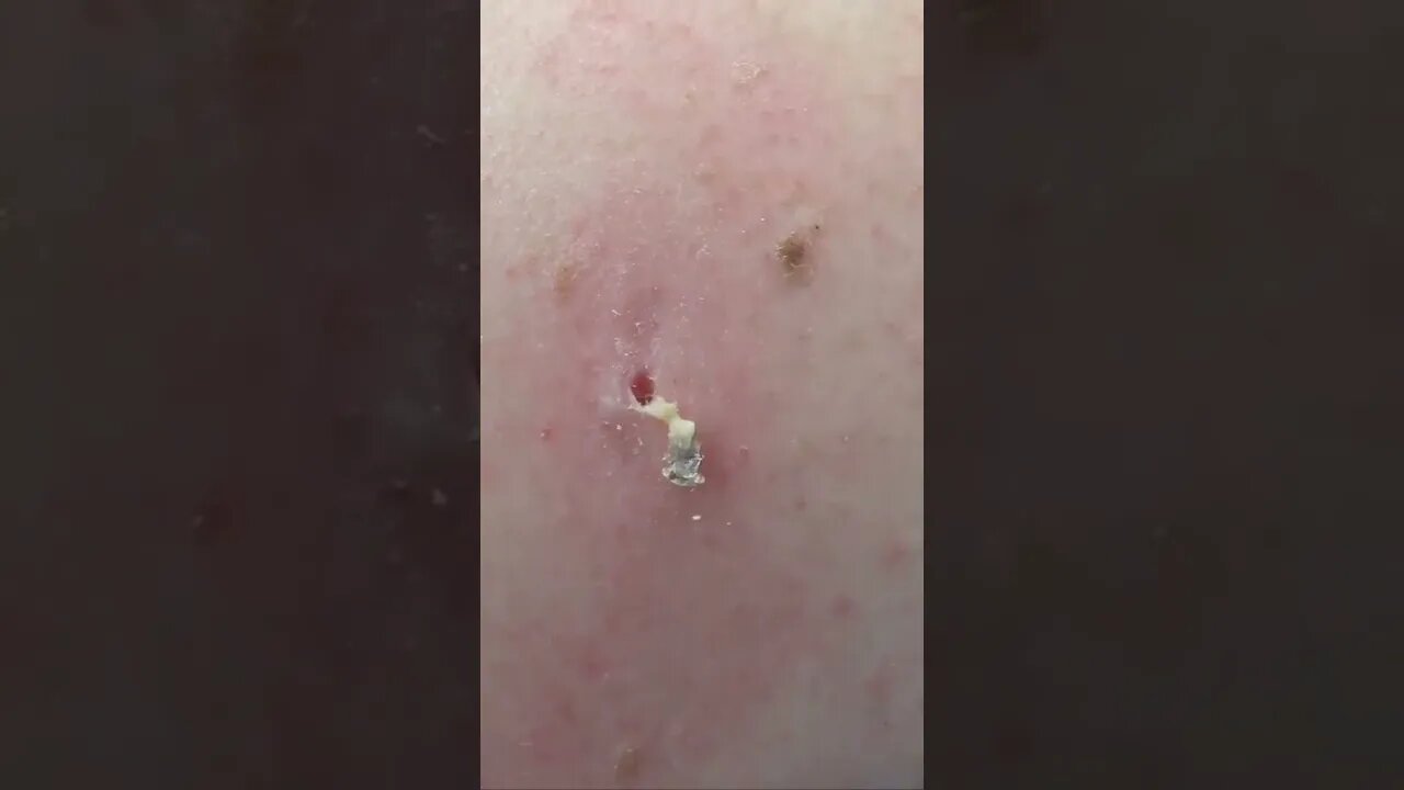 Remoção de Cravos e Espinhas - Remove Squeezing Blackheads and Pimples - Just Relax | Apenas Relaxe