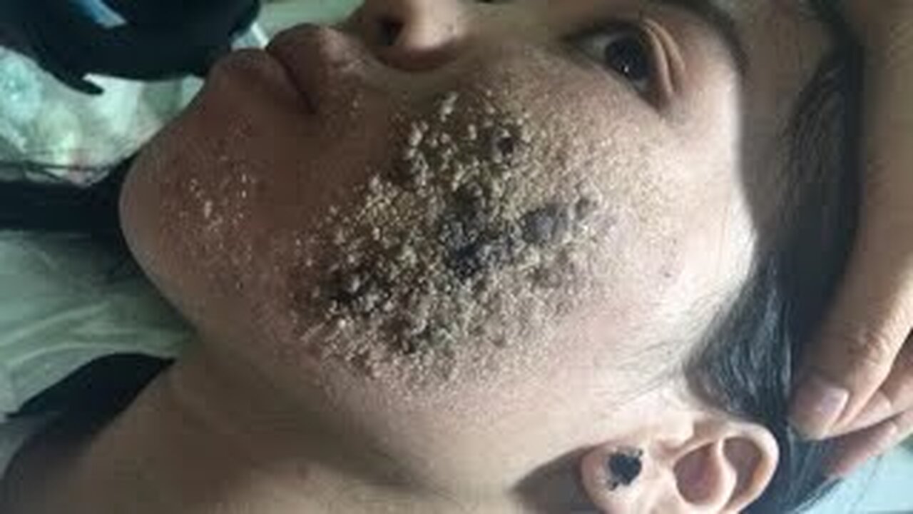 Big Cystic Acne Blackheads Extraction Blackheads & Milia, Whiteheads Removal Pimple Popping