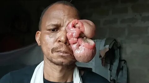 (Contact: +231-777-404-333 Serena) Man 42, seeks medical help for an eye disease that's killing him.