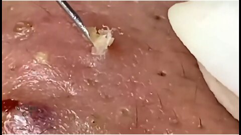 Massive Pore Cleaning!