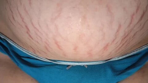 우리가 알아야할 튼살 96가지, 어느 코미디언의, 복부 초기튼살, 개그콘서트, St침, 체중증가, 다이어트, 감량, 심리적 스트레스, 몸개그