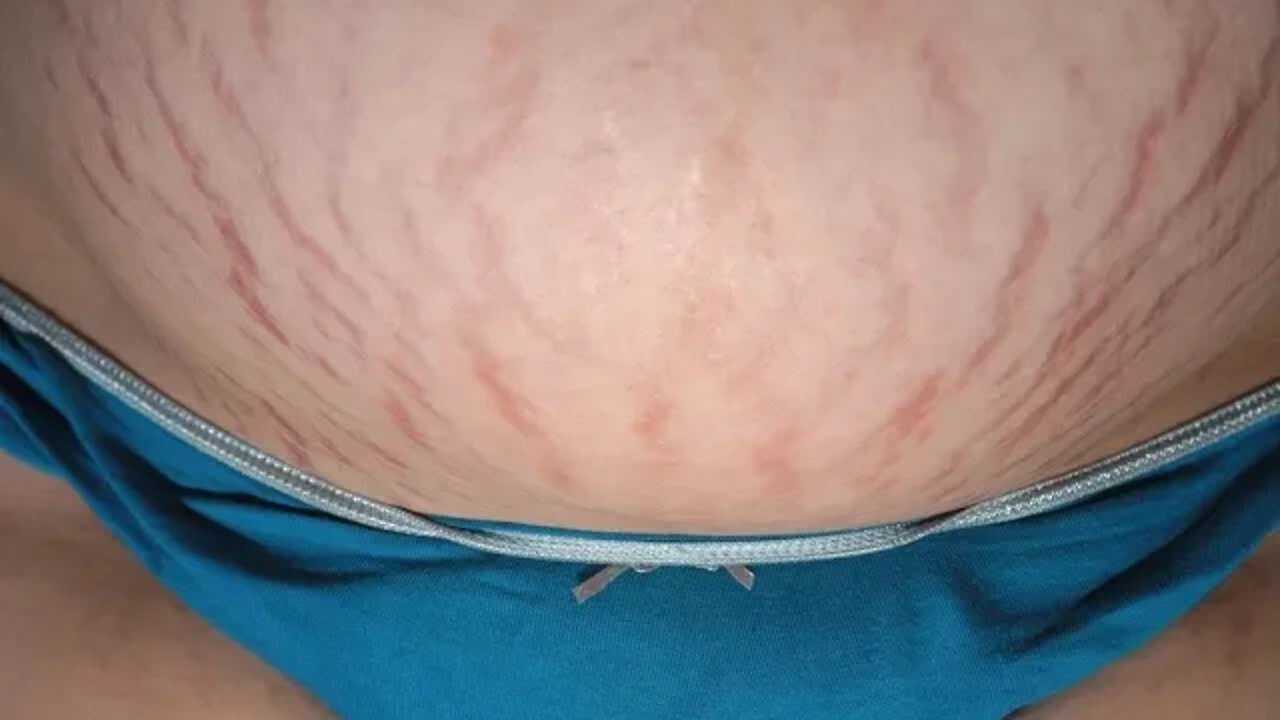 우리가 알아야할 튼살 96가지, 어느 코미디언의, 복부 초기튼살, 개그콘서트, St침, 체중증가, 다이어트, 감량, 심리적 스트레스, 몸개그