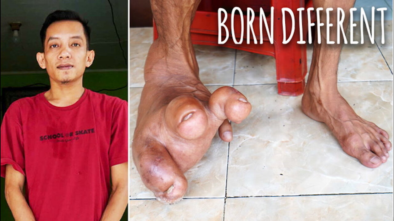 The Man With The Giant Foot | BORN DIFFERENT