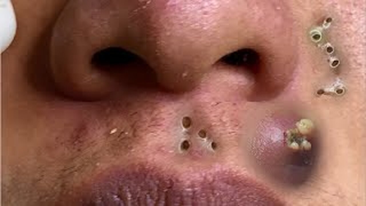 pimple popper, Satisfying blackheads removal and acne treatment on 113