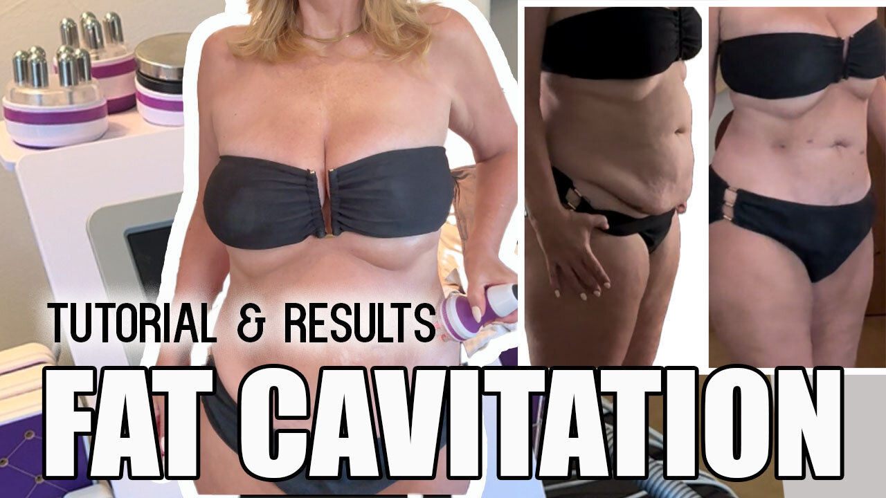 Fat Cavitation Tutorial & Results - Does it Work? Before & After