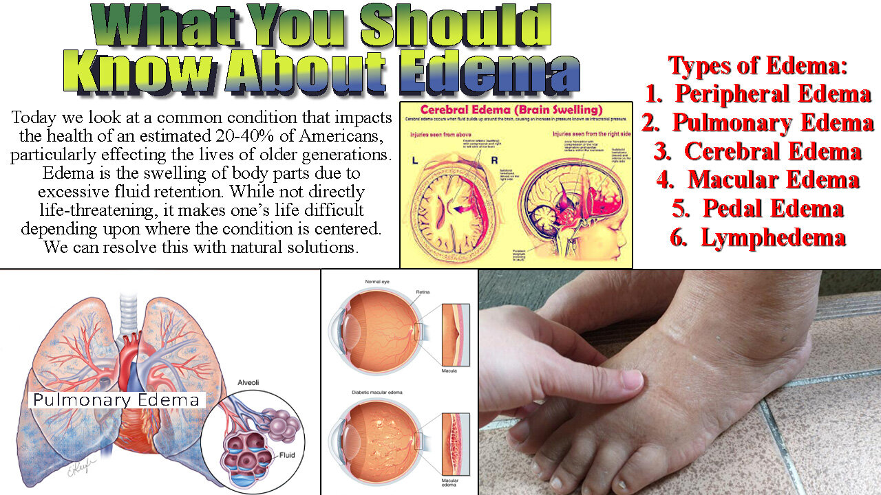 What You Should Know About Edema