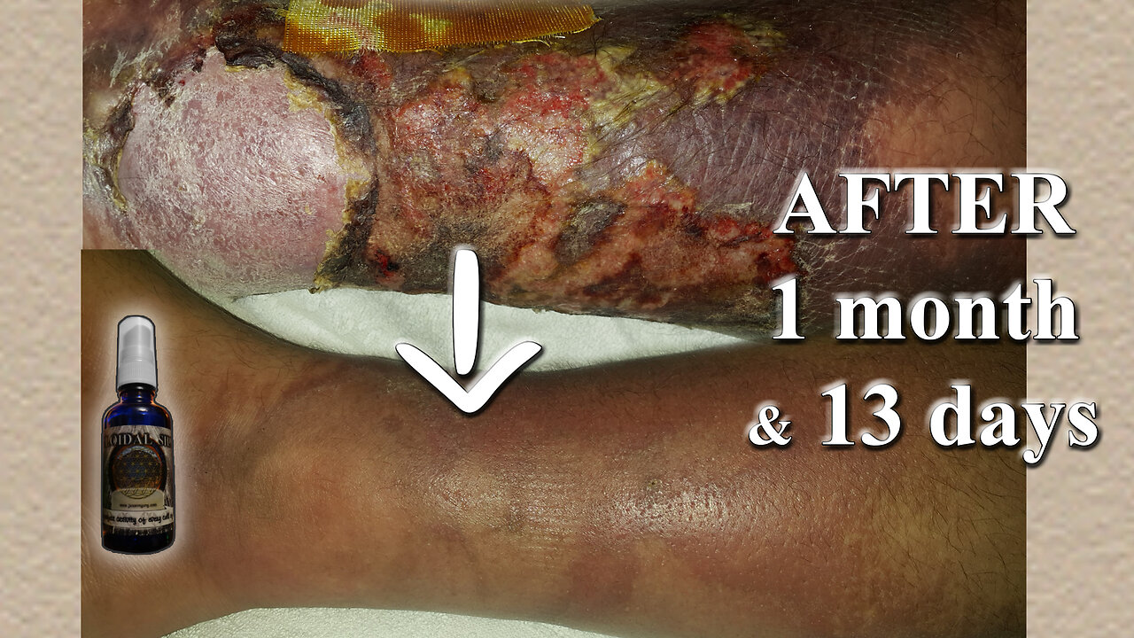 Insect bite & Colloidal Silver