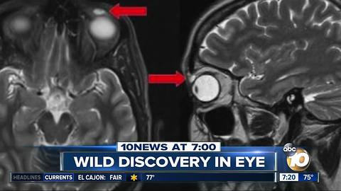 28-year-old contact lens found in eye?