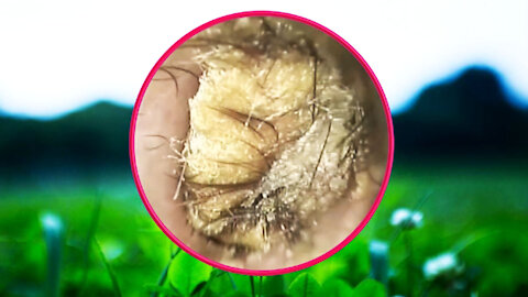 Ear Wax Removal With Clam Relaxing Music #39