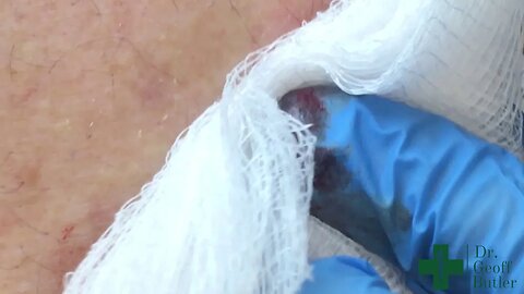 Removal of a superficial Epidermal Cyst with Minimal Rupture