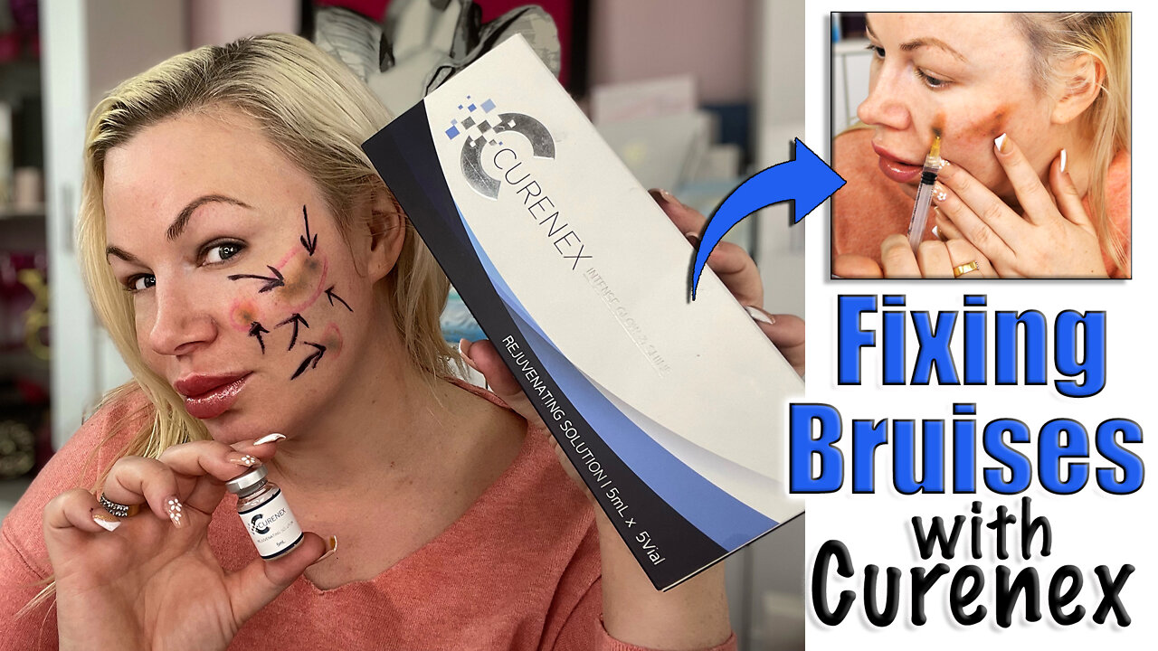 Fixing Bruises with Curenex from Acecosm.com | Code Jessica10 Saves you Money!