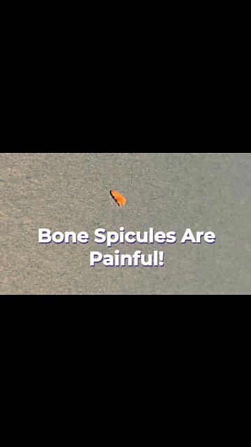 The Bone Spicule (boney protrusion) is NO MORE!!