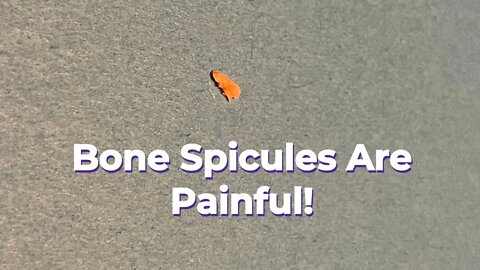 The Bone Spicule (boney protrusion) is NO MORE!!