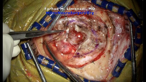 Surgical resection of atypical meningioma causing speech deficit. Brain tumor surgery.