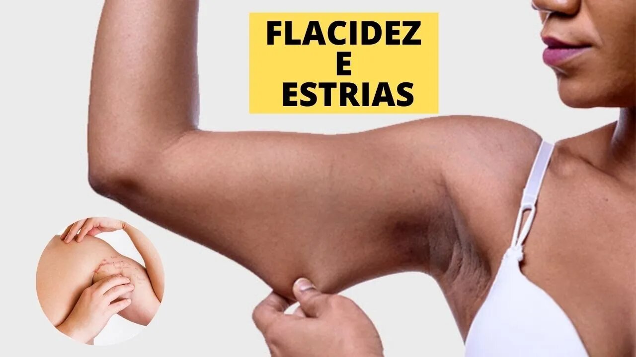 FLACIDEZ E ESTRIAS COMO PREVINIR, TRATAR E ALIMENTOS BONS