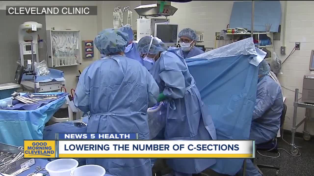 Cleveland Clinic working to reverse rising rates of cesarean sections