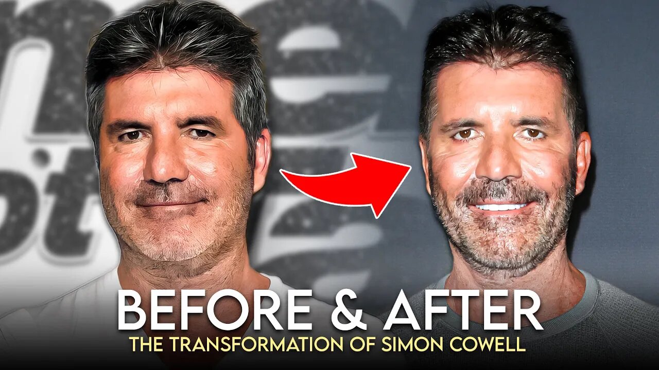 Simon Cowell | Before & After | What Happened To His Face?