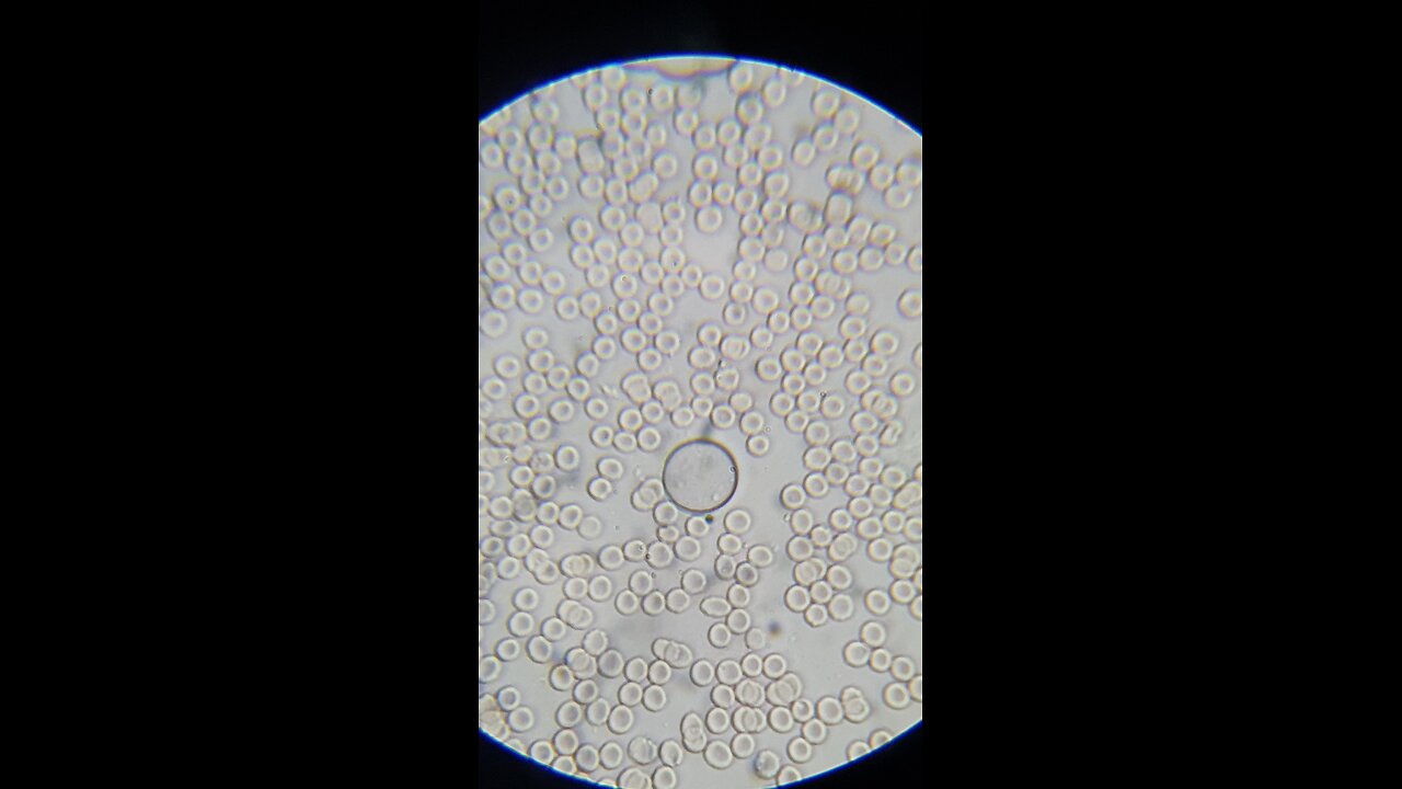 Rouleaux Formation Corrected With Aspirin