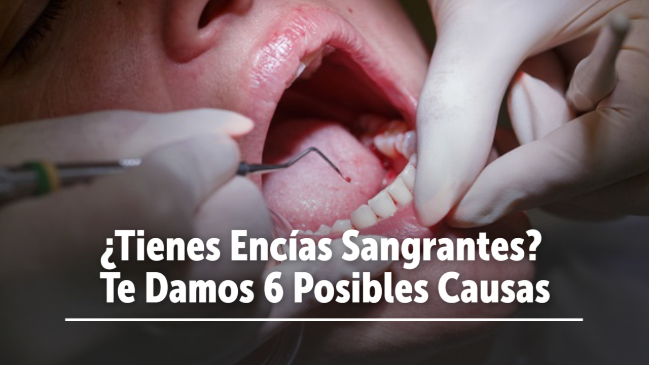 ¿Tienes Encías Sangrantes? Te Damos 6 Posibles Causas