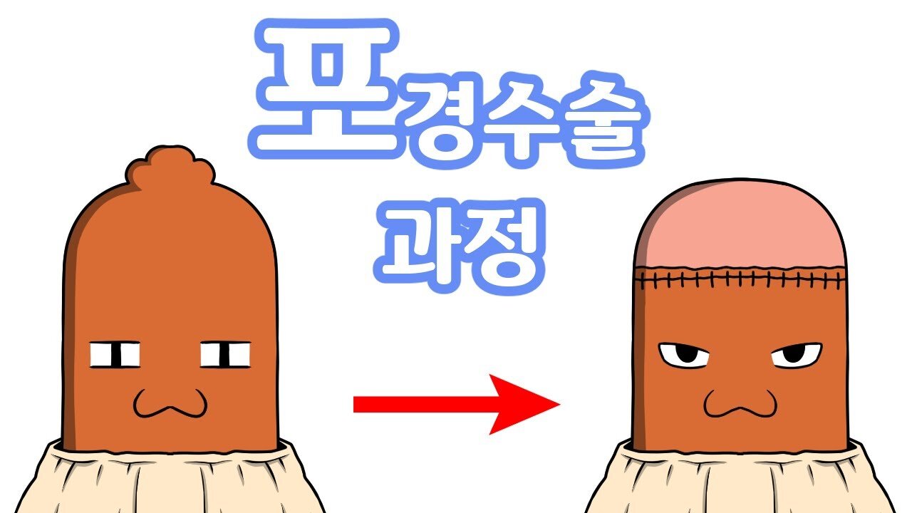 Circumcision Process Animation