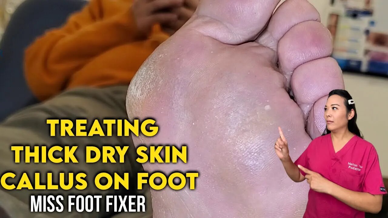 How to Remove Thick Dry Skin Callus on Foot - Best Tips and Treatment by podiatrist Miss Foot Fixer