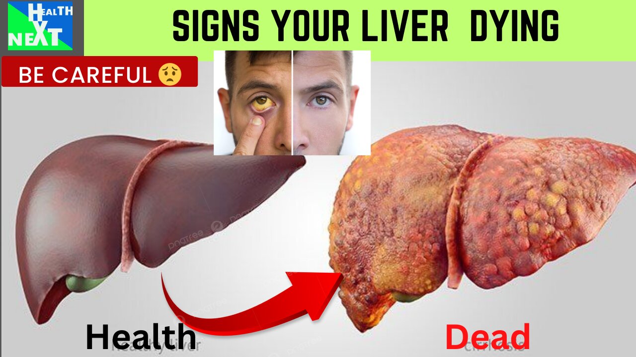 SIGNS YOUR LIVER IS DYING