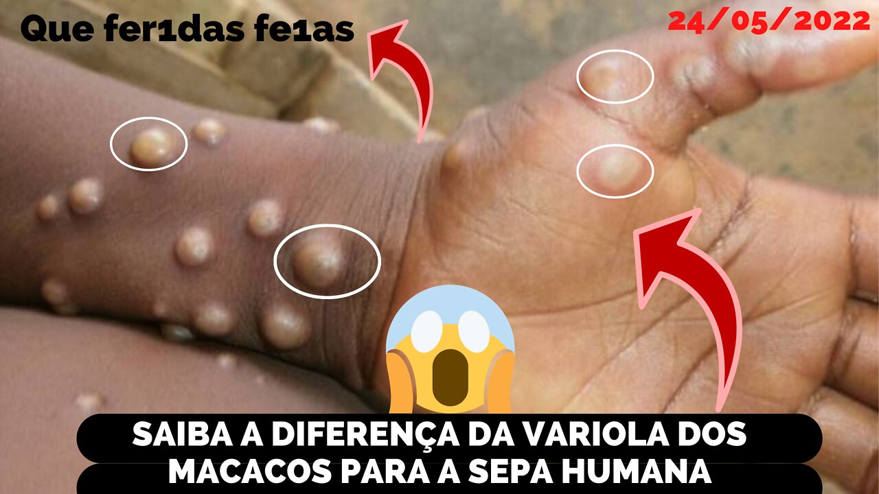 ENTENDA O QUE É A VARIOLA DOS MACACOS E A DIFERENÇA DESSA SEPA PARA A HUMANA