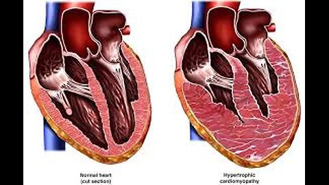 MEDITATION FOR HEART DISEASE!!