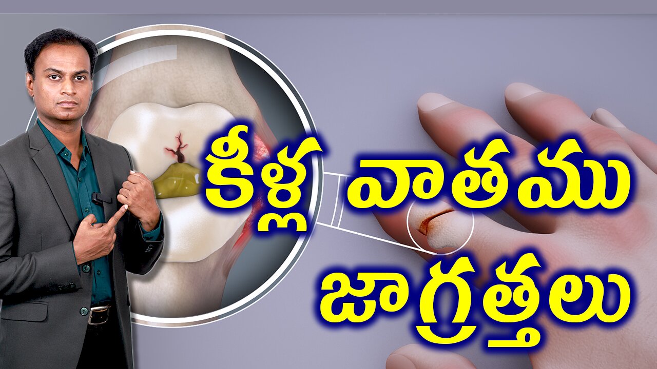 కీళ్ల వాతం కోసం జాగ్రత్తలు Precautions For Rheumatoid Arthritis Rheumatoid Arthtritis TreamtmentCure