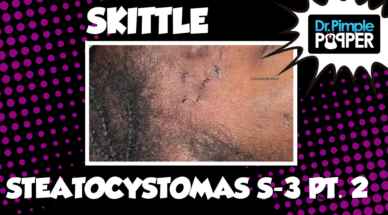 Skittle Steatocystoma, Session Three Part 2