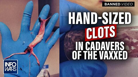 MUST SEE: Mortician Finds Massive Hand-Sized Clots In Cadavers After Vax