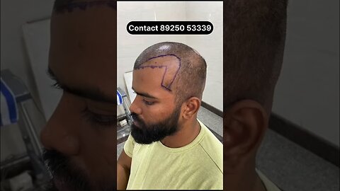 7 Month Hair Transplant Result