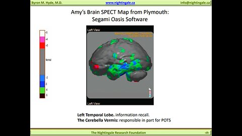 Amy Brown's M.E. Brain SPECT Scan - Byron Hyde, MD