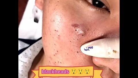 Pimple popping. How to remove blackheads