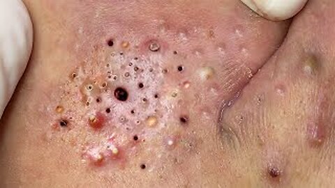 pimple popper, Satisfying, blackheads, tweezers, acne treatmen of 101