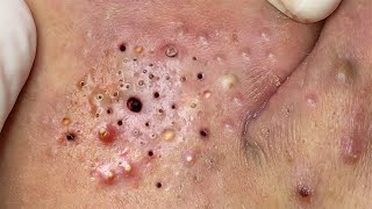 pimple popper, Satisfying, blackheads, tweezers, acne treatmen of 101