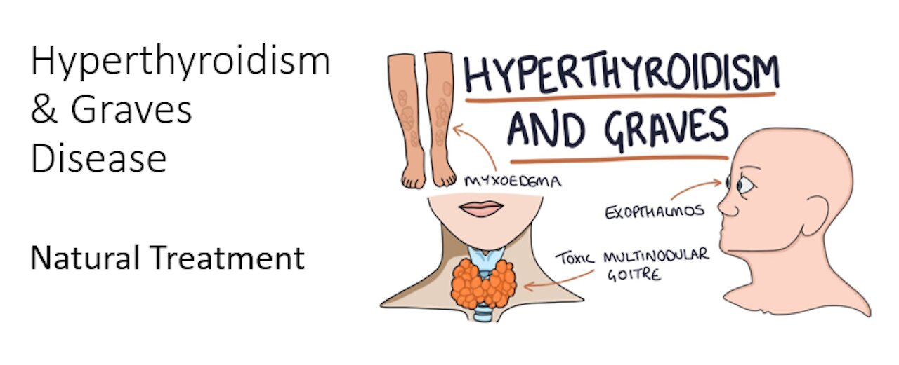 Hyperthyroidism & Graves disease Natural treatment