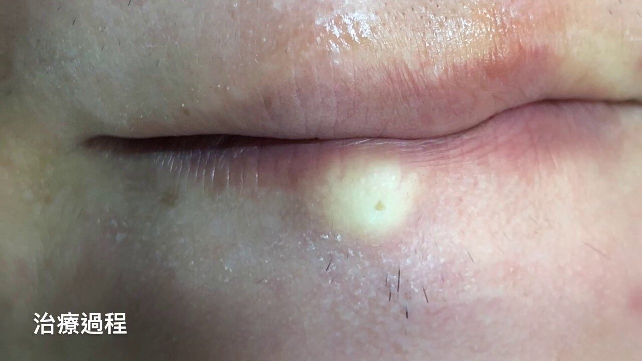 Epidermal Cyst, minimal incision, Dr George