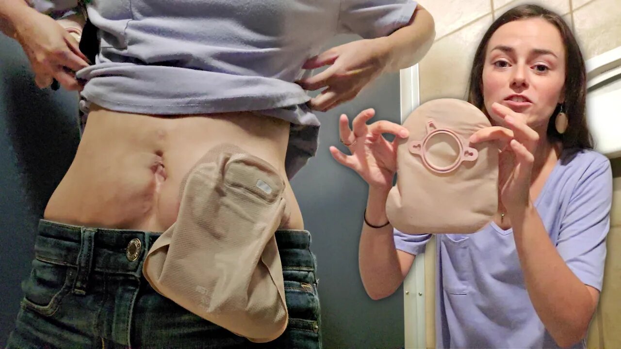 Day in the Life of an Ostomy Patient | Let's Talk IBD