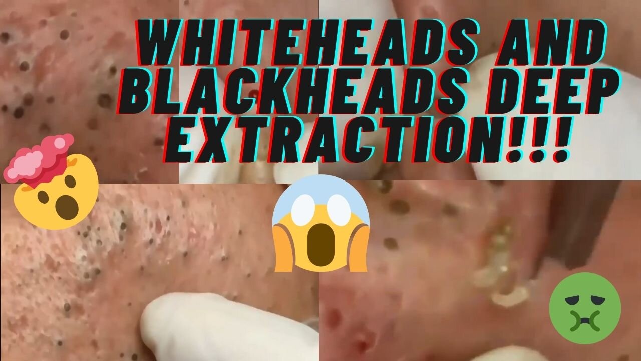 Deep cleaning of cystic acne | Blackheads removal | Whiteheads extraction on face!!!