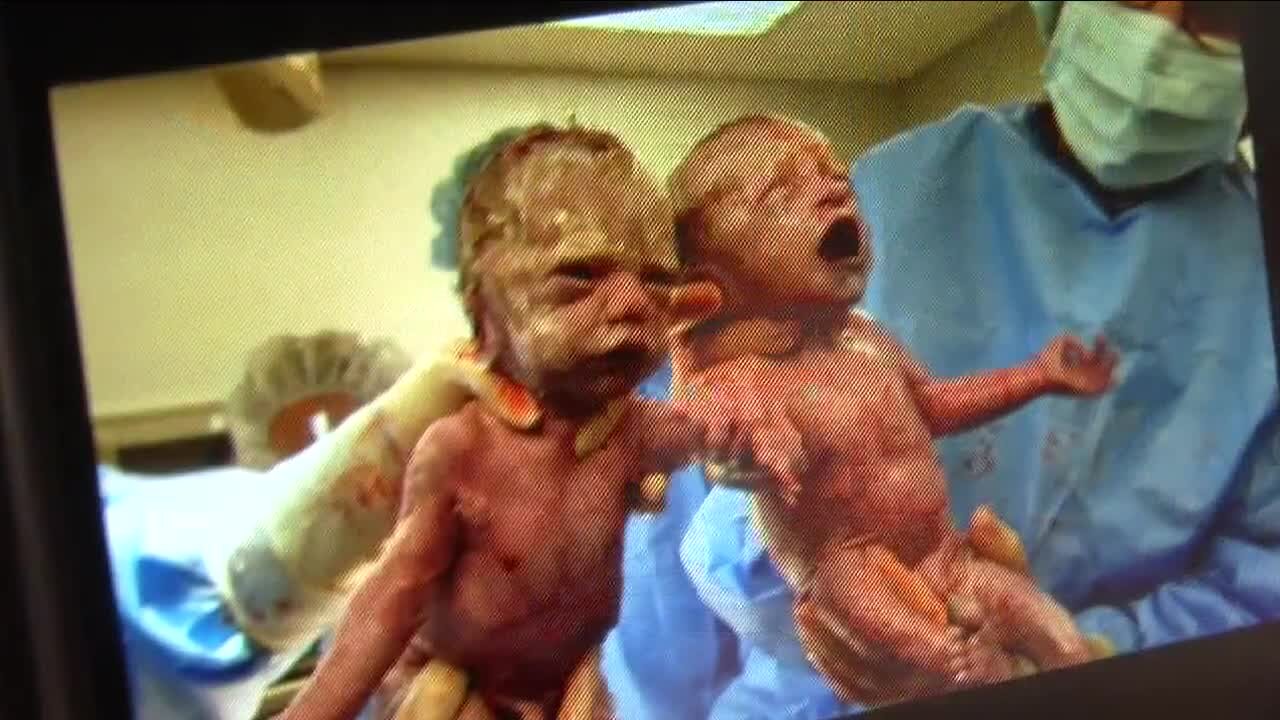 Rare 'mono mono' identical twins born holding hands turning 7 years old on Mother's Day