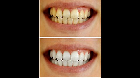 natural teeth whitener review teeth whitening natural teeth whitener professionally review whitener