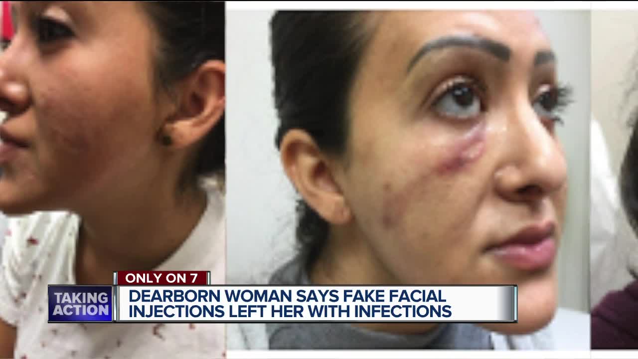 Woman says botched 'silicone' lip injections at metro Detroit salon led to oozing, infections